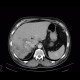 Splenic hemangioma, liver metastases, colon carcinoma: CT - Computed tomography
